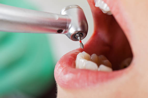 Best Knocked-Out Tooth (Avulsed Tooth) Treatment in Nitro, WV